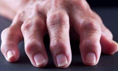 Was ist der Unterschied zwischen Arthrosis Arthritis