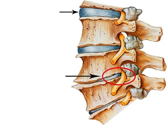 Intervertebral Discos Störungen