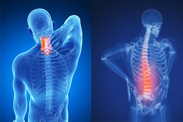 Osteochondrose der Hals- und Lendenwirbelsäule.