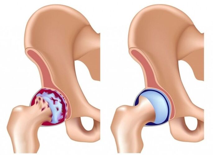Schädigung des Hüftgelenks durch Arthrose.