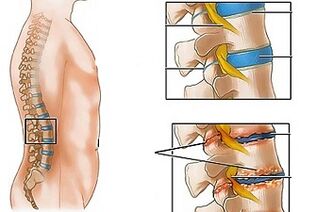 Die Ursachen der lumbalen Osteochondrose