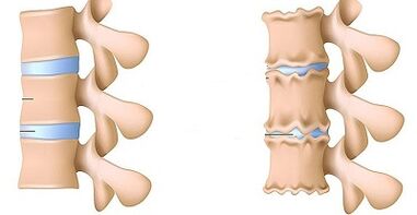 Wie man das Vorhandensein einer lumbalen Osteochondrose erkennt